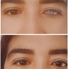 Imagen de Lente de Contacto Protésico Pupila Negra - Efecto Natural para Trauma Ocular | 1 Año de Duración