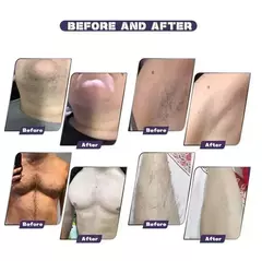 Laser Diodo Picosegundo Elimina vello y Tatuaje con Laser De Carbono Permanente 2 En 1 - comprar en línea