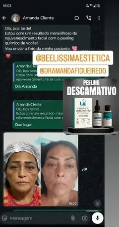 PEELING 3D DESCAMATIVO na internet