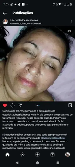 COMBO PEELING 3D + SABONETE GLICÓLICO 10% E SALICÍLICO 2% - loja online