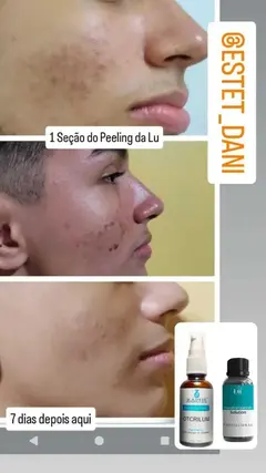 Imagem do COMBO PEELING + KIT LIMPEZA DE PELE + FATOR DE CRESCIMENTO