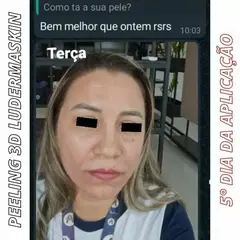 COMBO PEELING + KIT LIMPEZA DE PELE + FATOR DE CRESCIMENTO