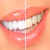 Comparação de dentes branqueados e não branqueados, destacando o clareamento dental.