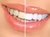 Imagem de sorriso mostrando dentes antes e depois do clareamento dental com Kit Clareador Whiteness Perfect 22% - FGM.