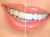 Comparação de dentes antes e depois do clareamento dental, mostrando a diferença de tonalidade.