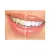 Comparação de dentes antes e depois do clareamento dental com o Clareador Dental Whiteness Class 10%.