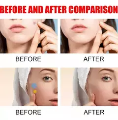 Parche Acne + Mini Depilador Facial