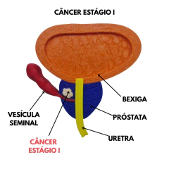 Modelo de Próstatas com Câncer - meu CLITÓRIS minhas REGRAS 