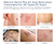 MURASAKI BEAUTY® Scar Gel - Gel de Silicona para Cicatrices de Cesáreas, Estrías, Acné y Cirugía, Efectivo para Cicatrices Nuevas y Antiguas - Styla