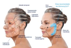 HARMONYCA - ALLERGAN PREENCHIMENTO E BIOESTIMULO DE COLÁGENO - comprar online