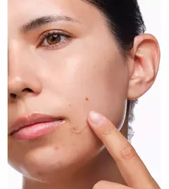 The Ordinary-the Acne Set. en internet