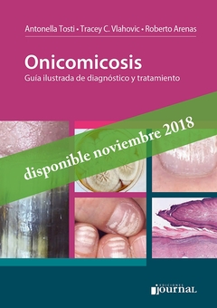 ONICOMICOSIS