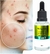 Sérum Max Love Antiacne 10 em 1 - Floritudo
