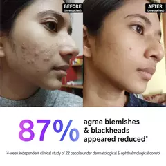 Limpiador de acné y puntos negros con ácido salicílico - ProSkin Estética