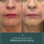 Preenchimento com Ácido Hialurônico - Beauty365