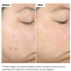 THE ORDINARY- Salicylic Acid 2% Exfoliating Blemish Solution - tienda online