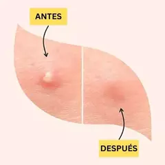 Parche para acne invisible - Sonycom