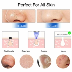 SkinClear Pro® Removedor de Puntos Negros/Espinillas - Crescendo Hogar