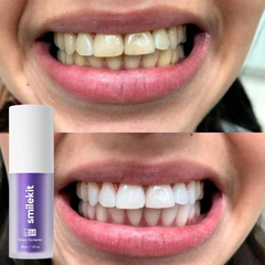 SmileKit V34 - Tus dientes más blancos - By Sofi Savoy - CarbonWhite