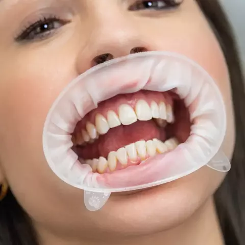 OptraGate