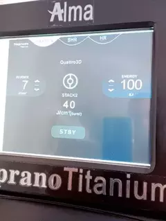 LASER DE DEPILAÇÃO 808NM SOPRANO TITANIUM | TECNOLOGIA ALMA – 2500W DE POTÊNCIA PROFISSIONAL - HF - House Farma