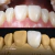 Resina Quanton Athom Dental - loja online