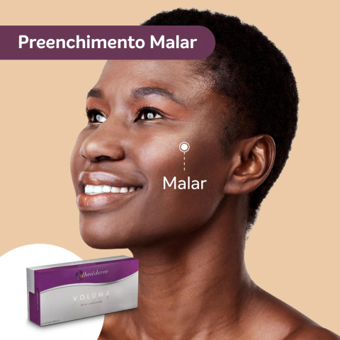 Preenchedor de Malar - Juvéderm