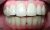 PIERCING DENTAL (x1 UNIDAD) COLOR A ELECCION