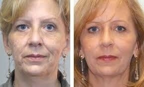Imagem do Acido Retinóico 10% Puro + Sabonete Peeling 60ml + Protetor