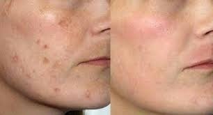 2 Acidos Retinóico 20% 15g Puro + 1 Sabonete Pré Peeling - loja online
