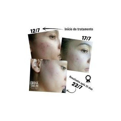 Peeling Ácido Kojico Puro 30% + Sabonete Peeling 110ml - loja online