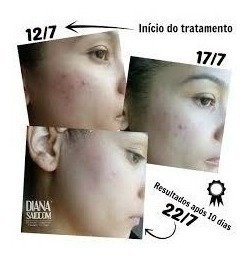 Ácido Kojico 1% 30ml + Sabonete Peeling 60ml Manchas E Rugas - loja online