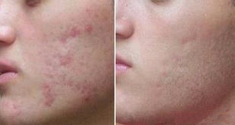 Acido Retinóico 20% Puro Profissional 10g + Sabonete Peeling 60ml - loja online