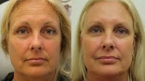 Imagem do Ácido Peeling Kojico 20% + Tranexâmico 5% + Vitamina C 30%
