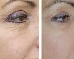 Ácido Hialurônico 50% Rejuvenescedor Facial Solução 30ml - comprar online