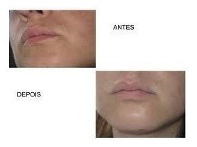 Ácido Retinóico 10% Peeling 30ml + Sabonete Peeling 60ml - Clean Face Skin