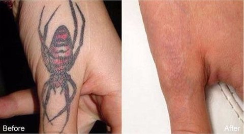 Peeling Ácido Removedor De Tatuagens E Micro Pigmentações na internet