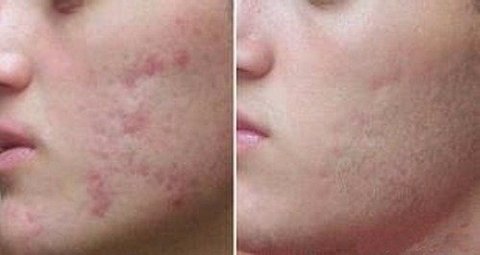 Acido Retinoico 15% Puro + Sabonete Pré E Pós Peeling 60ml - Clean Face Skin