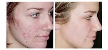 Acido Retinóico 20% 20g + Sabonete Pré E Pós Peeling 60ml - comprar online