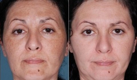 Ácido Retinoico 20% 15g Puro + Sabonete Pré Peeling - Clean Face Skin