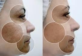 Ácido Salicílico 10% Com Ácido Lactico 5% 30ml + Sabonete - Clean Face Skin