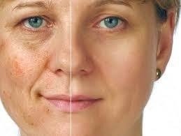 Peeling Fenol 10% Anti Idade Rugas Manchas Flacidez 10ml + Neutralizante - comprar online