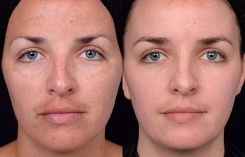 Peeling Ácido Lático 30% 30 Ml - Clean Face Skin