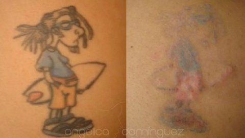 Peeling Ácido Removedor De Tatuagens E Micro Pigmentações - Clean Face Skin