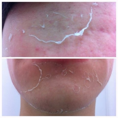 Ácido Retinoico 40% Creme+ Sabonete - Clean Face Skin