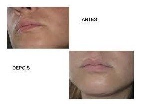 Ácido Retinóico 5% 15g Puro + Sabonete Pré Peeling - loja online