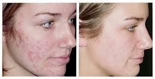 Ácido Azeláico 40% + Sabonete Pré Peeling ( Anti Acneico ) na internet