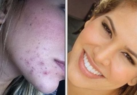 Imagem do Acido Retinoico 15% Puro + Sabonete Pré E Pós Peeling 60ml