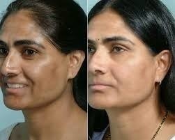 Imagem do Acido Retinóico 30% Puro Profissional + Sabonete Pré Peeling
