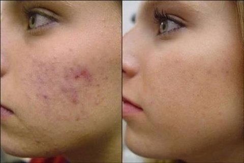 Acido Retinoico 15% Puro + Sabonete Pré E Pós Peeling 60ml na internet